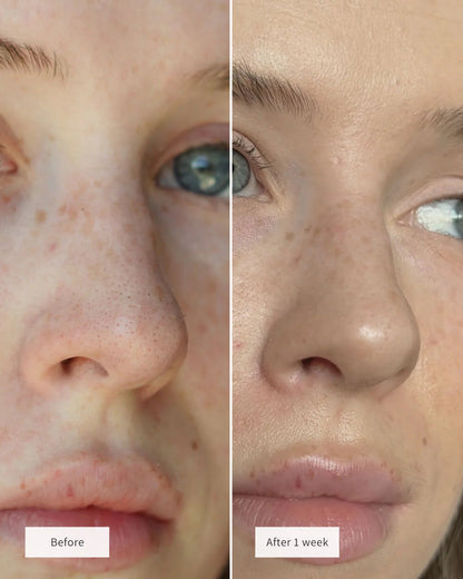 Hydrocolloid Nose Patch ✨ Overnight Blackhead Remover
